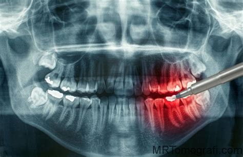 diş röntgeni çeşitleri